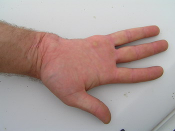 csonkolt ujj gyógyulása izom és ízületi fájdalom a kemoterápia után